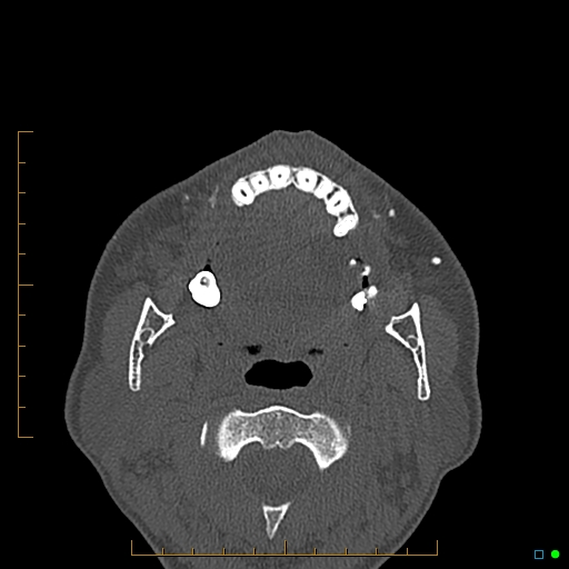 Calcified facial augmentation fillers (Radiopaedia 79514-92679 Axial bone window 94).jpg