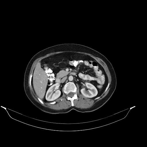 File:Calcified hydatid cyst of the liver (Radiopaedia 21212-21112 A 16).jpg