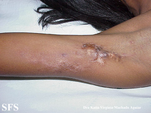 Calcinosis Circumscripta-Idiopathic (Dermatology Atlas 1).jpg