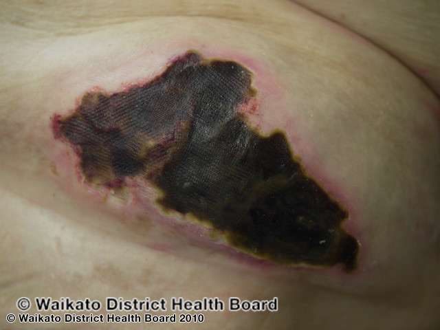 File:Calciphylaxis can lead to- (DermNet NZ systemic-w-calciphylaxis8).jpg