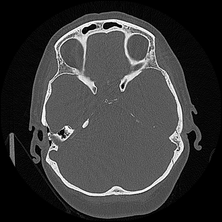 Canal up mastoidectomy (Radiopaedia 78108-90638 Axial bone window 108).jpg