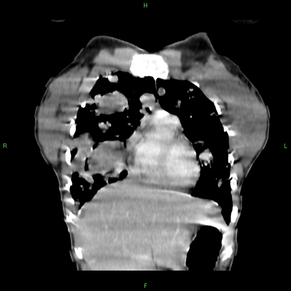 File:Cannon ball metastases - synovial sarcoma (Radiopaedia 26135-26271 Coronal liver window 1).jpg