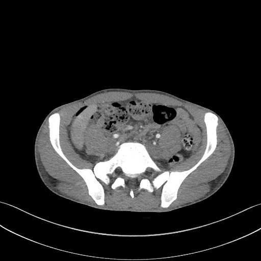 Cannonball metastases - testicular choriocarcinoma (Radiopaedia 84510-99891 B 161).jpg