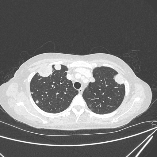 Canonball lung metastasis (Radiopaedia 77634-89837 Axial lung window 43).jpg