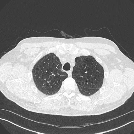Caplan syndrome (Radiopaedia 56667-63530 Axial lung window 46).jpg