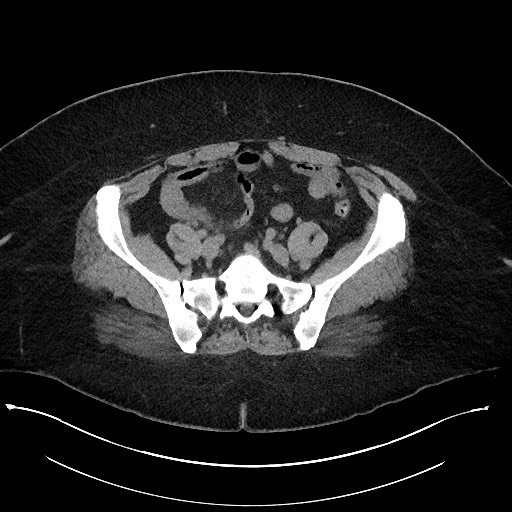 Carcinoid tumor - terminal ileum (Radiopaedia 60931-68740 Axial non-contrast 86).jpg