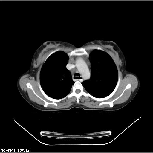 File:Carcinoma of esophagus (Radiopaedia 27356-27550 A 24).jpg