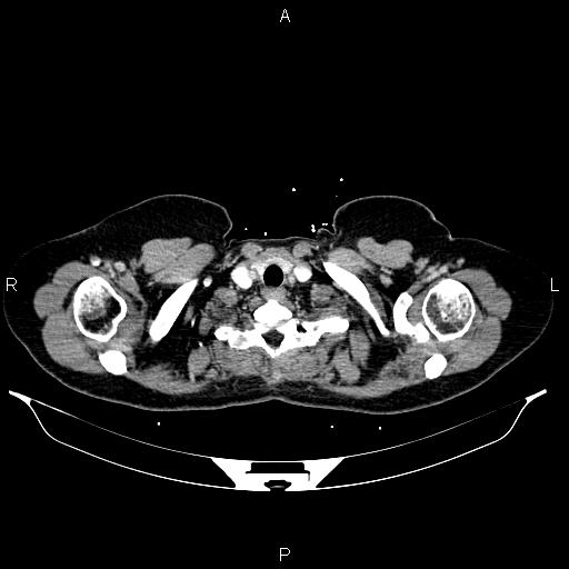 File:Carcinoma of uterine cervix (Radiopaedia 85861-101700 A 6).jpg