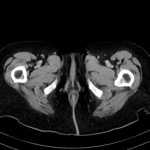 Carcinosarcoma (Radiopaedia 70401-80503 A 77).jpg