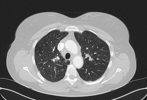 Cardiac sarcoidosis (Radiopaedia 74548-85534 Axial lung window 26).jpg