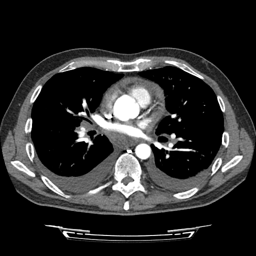 Cardiac tamponade (Radiopaedia 78607-91368 Axial C+ CTPA 45).jpg