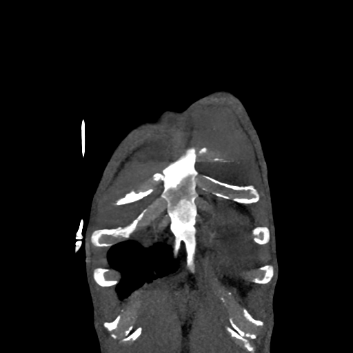Cardiac tumor - undifferentiated pleomorphic sarcoma (Radiopaedia 45844-50134 Coronal non-contrast 2).png