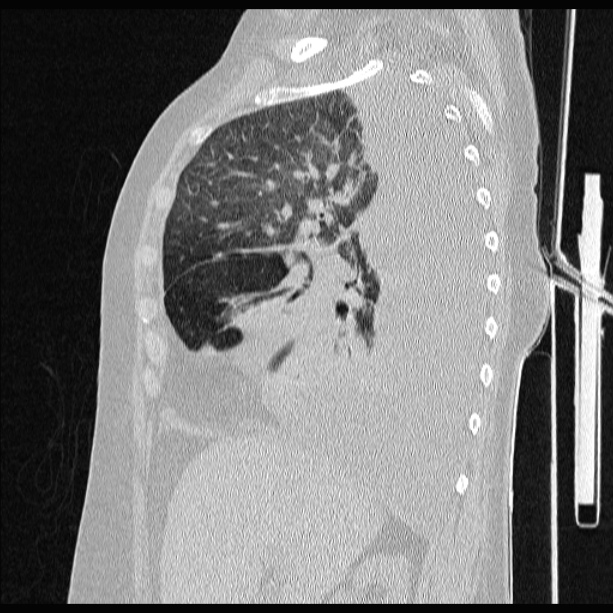 Cardiogenic pulmonary edema (Radiopaedia 29213-29609 Sagittal lung window 33).jpg