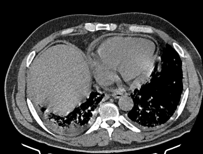 Cardiogenic pulmonary edema (Radiopaedia 68180-77678 Axial non-contrast 40).jpg