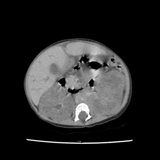 Caroli disease with autosomal recessive polycystic kidney disease (ARPKD) (Radiopaedia 89651-106703 B 104).jpg