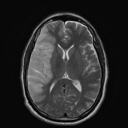 File:Carotid arterial dissection with acute cerebral infarction (Radiopaedia 26636-26784 Axial T2 12).jpg