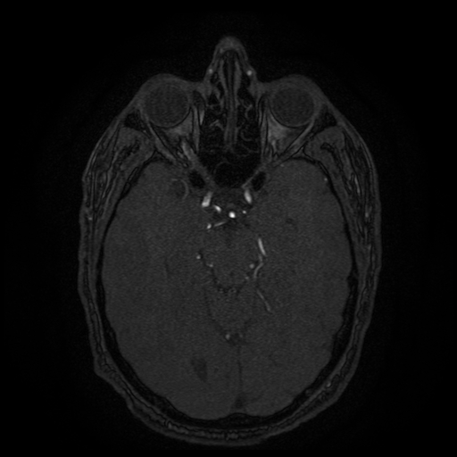Carotid arterial dissection with acute cerebral infarction (Radiopaedia 26636-26784 MRA 102).jpg