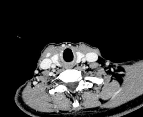 Carotid body tumor (Radiopaedia 61750-69757 Axial Post contrast 93).jpg