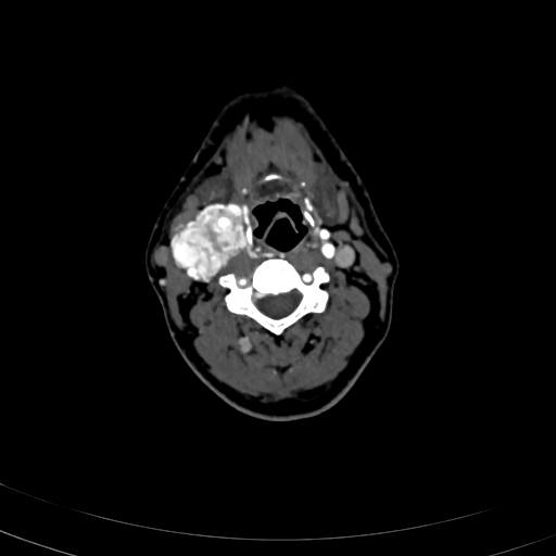 Carotid body tumor (Radiopaedia 83615-98727 A 58).jpg