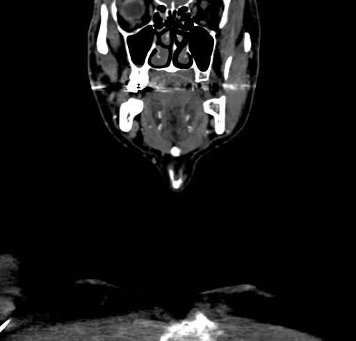 File:Carotid body tumor (Radiopaedia 83615-98727 B 28).jpg