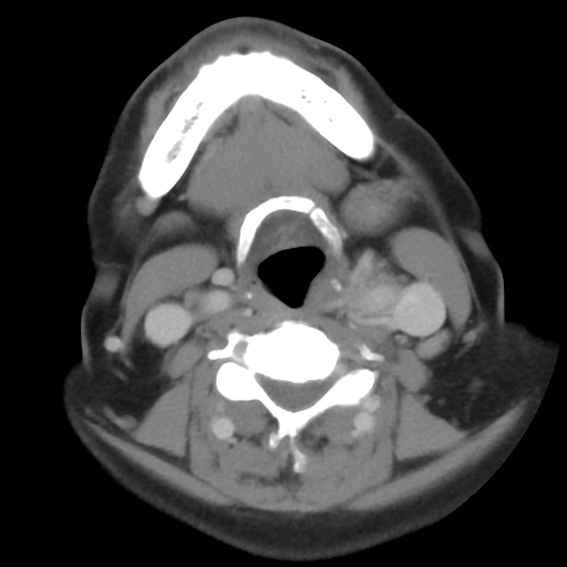 Carotid body tumor (paraganglioma) (Radiopaedia 38586-40729 A 20).jpg