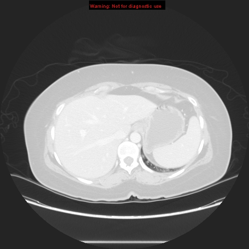 Carotid body tumor with lung metastases (Radiopaedia 9301-48390 Axial lung window 61).jpg