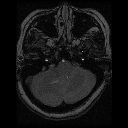 Cavernoma, DVA and right ICA aneurysm (Radiopaedia 33890-35072 E 89).png
