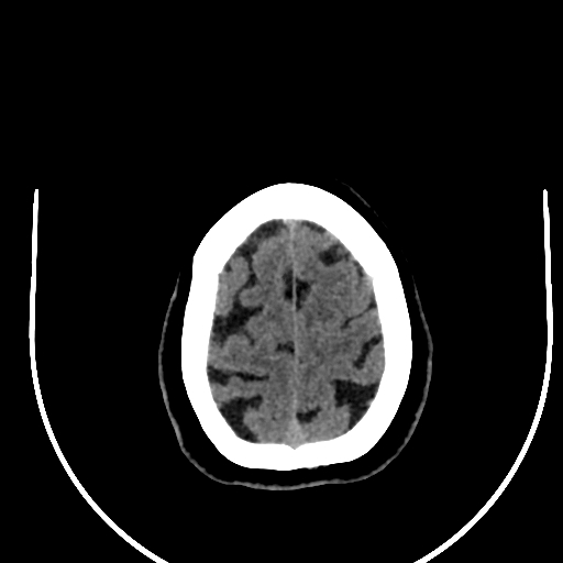 Cavernous hemangioma of the cerebellar falx (Radiopaedia 73025-83723 Axial non-contrast 121).jpg