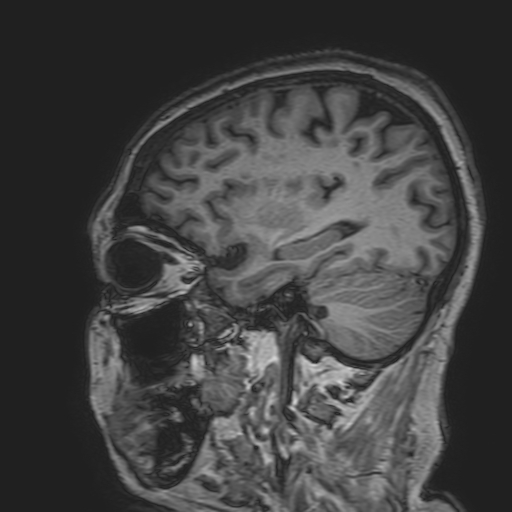 File:Cavernous hemangioma of the cerebellar falx (Radiopaedia 73025-83724 Sagittal T1 61).jpg