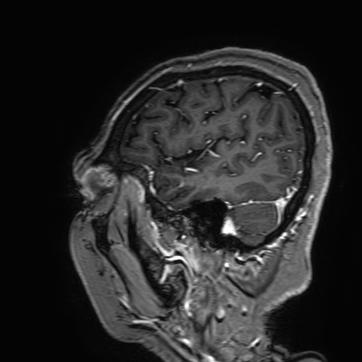 Cavernous hemangioma of the cerebellar falx (Radiopaedia 73025-83724 Sagittal T1 C+ 173).jpg