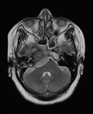 File:Cavernous sinus meningioma (Radiopaedia 63682-72367 Axial T2 6).jpg
