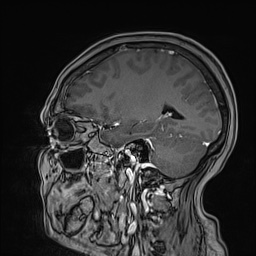 Cavernous sinus meningioma (Radiopaedia 63682-72367 Sagittal T1 C+ 116).jpg