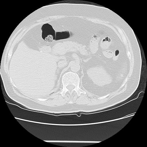 Cavitating pulmonary metastases (Radiopaedia 89545-106544 Axial lung window 59).jpg