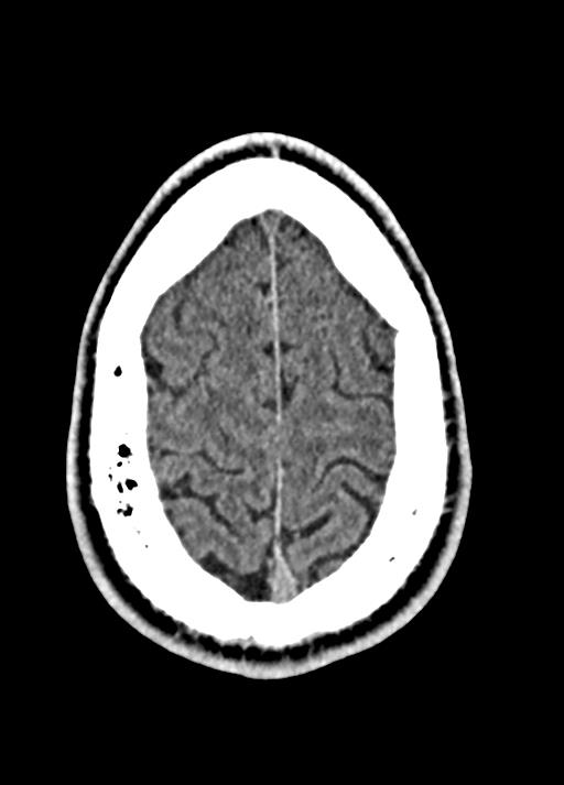 Cavum septum pellucidum and cavum vergae (Radiopaedia 77797-90060 Axial Brain Window 90).jpg