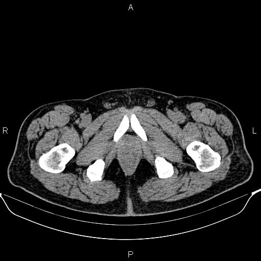 Cecal adenocarcinoma (Radiopaedia 85324-100916 Axial non-contrast 105).jpg