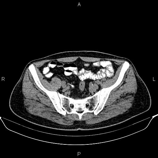 Cecal adenocarcinoma (Radiopaedia 85324-100916 Axial non-contrast 77).jpg