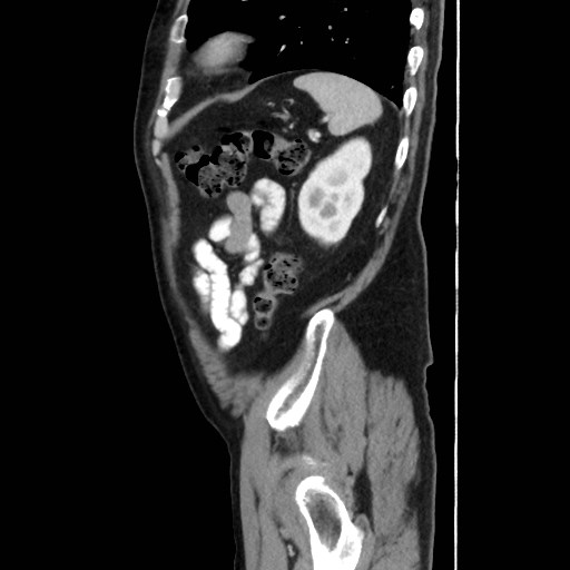 Cecal mass causing appendicitis (Radiopaedia 59207-66531 C 53).jpg