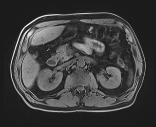 Cecal mass causing appendicitis (Radiopaedia 59207-66532 Axial T1 53).jpg