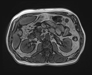 Cecal mass causing appendicitis (Radiopaedia 59207-66532 D 57).jpg