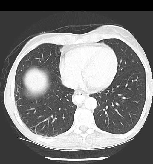 File:Cecal volvulus (Radiopaedia 48543-53513 Axial lung window 6).jpg