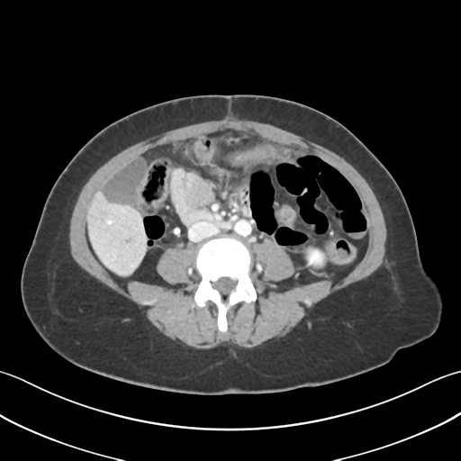 Cecum hernia through the foramen of Winslow (Radiopaedia 46634-51112 A 39).png