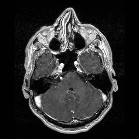 Central-variant posterior reversible encephalopathy syndrome (PRES) (Radiopaedia 43880-47358 Axial T1 C+ 34).jpg