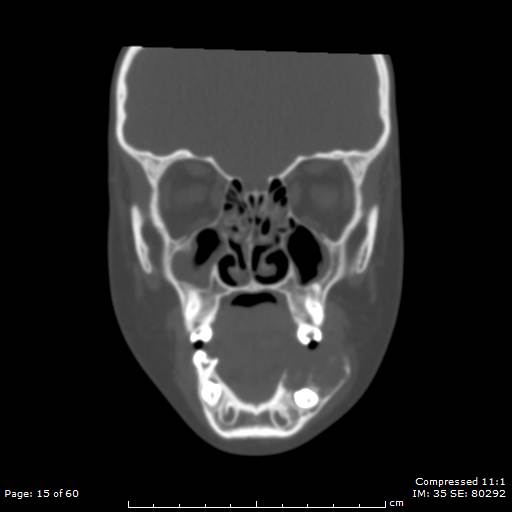 Central giant cell granuloma (Radiopaedia 45612-49754 Coronal bone window 15).jpg