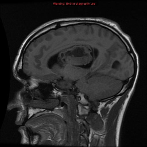 File:Central neurocytoma (Radiopaedia 13188-13206 Sagittal T1 11).jpg