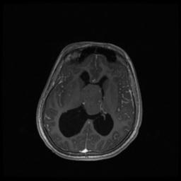 Central neurocytoma (Radiopaedia 30220-30842 Axial T1 C+ 83).jpg