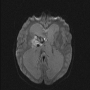 Central neurocytoma (Radiopaedia 56690-63469 Axial DWI 29).jpg