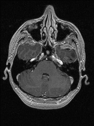 Central neurocytoma (Radiopaedia 56690-63469 Axial T1 C+ 41).jpg