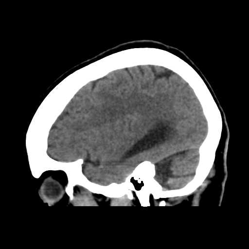 File:Central neurocytoma (Radiopaedia 65317-74346 C 15).png