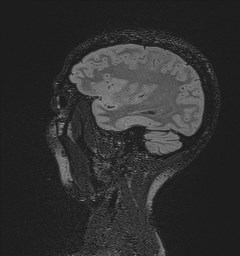 Central neurocytoma (Radiopaedia 84497-99872 Sagittal Flair + Gd 41).jpg