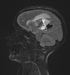 File:Central neurocytoma (Radiopaedia 84497-99872 Sagittal Flair + Gd 91).jpg